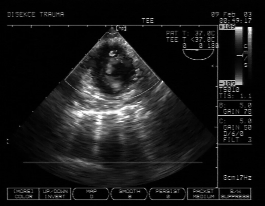 Příjem polytraumatu, který měl nejasný stín v mediastinu a rozšíření aorty na CT Na TEE je patrna traumatická disekce sestupné aorty s pravým lumen v levé dolní (z pohledu pacienta) části sektoru dopplerometrie, turbulence nahoře je vstup do falešného lumen. Pacient podstoupil urgentní stenting.