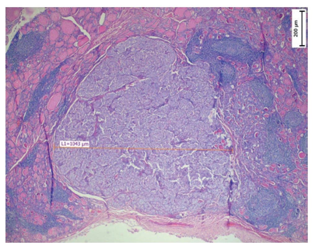 Papilární mikrokarcinom (MPTC) o velikosti 1 mm<br>
Fig. 1: Papillary microcarcinoma with the diameter of 1mm