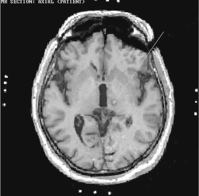 Stav po stereotaktické radiofrekvenční koagulaci nucleus ventralis intermedius v terapii esenciálního třesu
Fig. 1. Status post nucleus ventralis intermedius stereotactic radiofrequency coagulation in the treatment of essential tremor