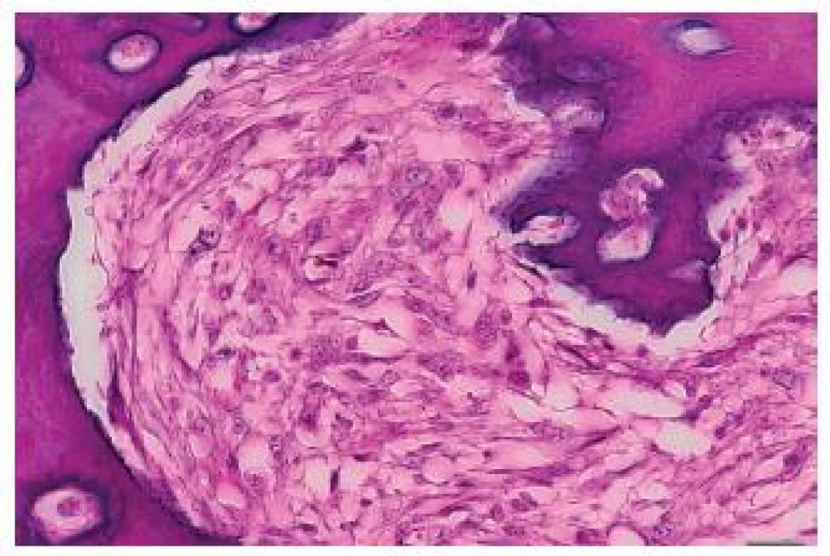 Irregular bone trabeculae of the metastasis of a malignant phyllodes tumor with osteosarcomatous differentiation to the heart. Close to the trabeculae, elongated tumor cells are seen. HE, scale bar 20 μm.