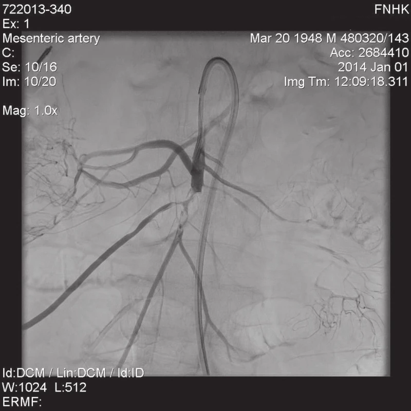 Angiografie AMS
Cévní uzávěr kmene horní mezenterické tepny 5 cm od odstupu v délce 17 mm.
Fig. 1: Angiography of the superior mesenteric artery 
Vascular closure of the superior mesenteric artery trunk 5 cm from its origin, 17 mm long.