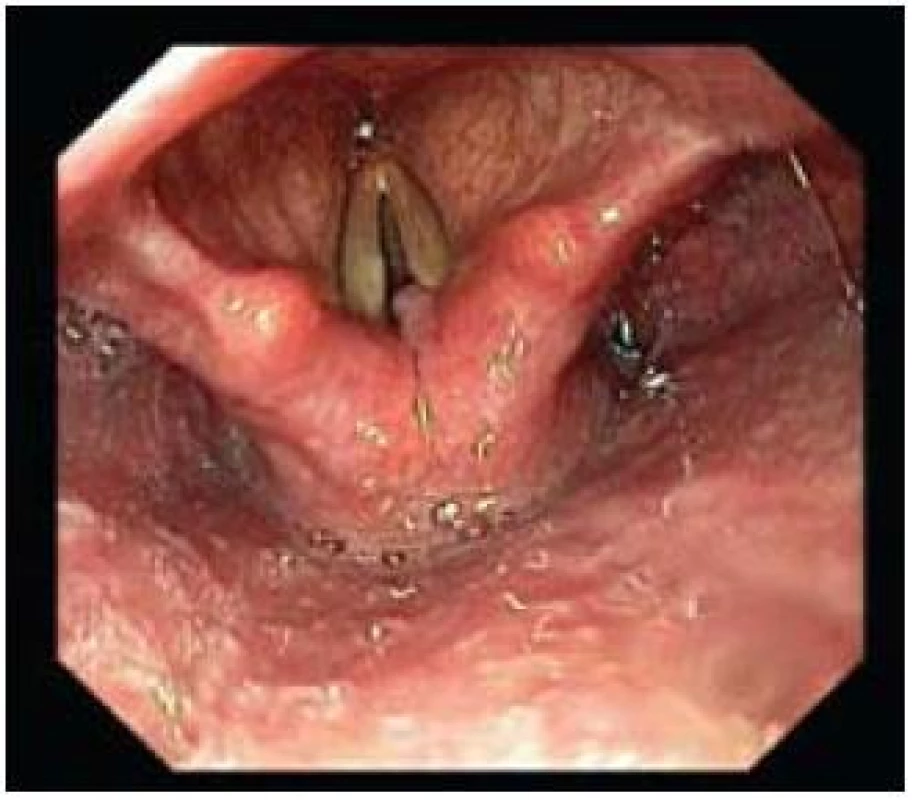 Granulom pravé hlasivky.
Fig. 8. Granuloma of the right vocal cord.