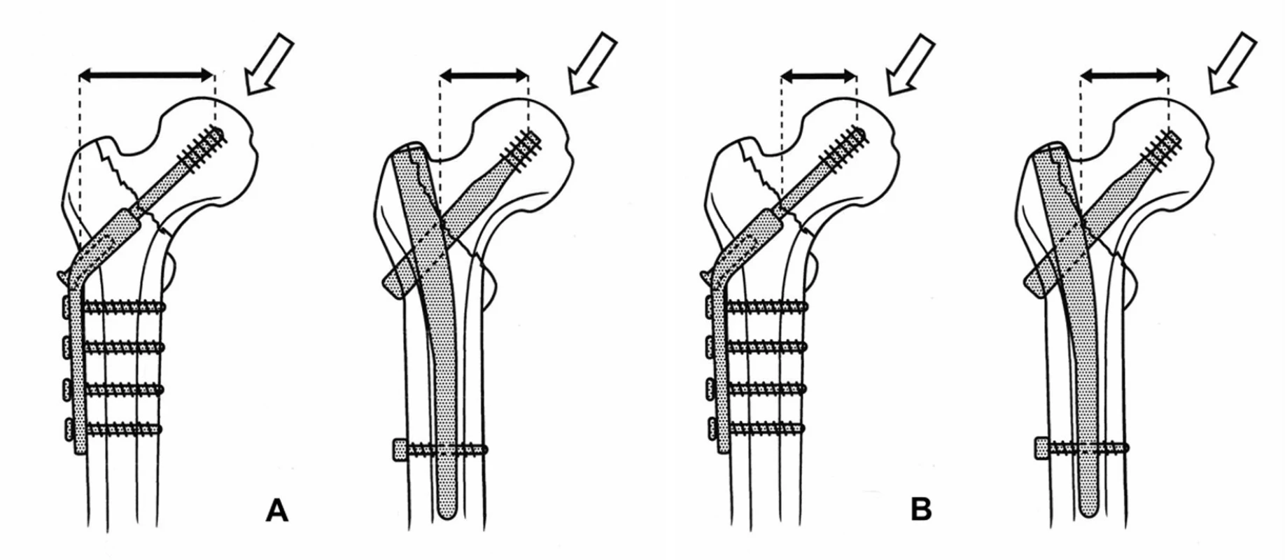 Biomechanika DHS a PFN: a – u DHS je ohybové namáhání dlahy větší než u PFN; b – ohybové síly působící na spojení skluzného hřebu a hlavice femuru jsou u obou implantátů stejné (podrobně vysvětlení v textu). 
Fig. 3: Biomechanics in DHS and PFN: a – bending forces in DHS are greater than in PFN; b – bending forces acting on the interface of DHS and the femoral head are the same in both the implants (for a detailed explanation see the text).