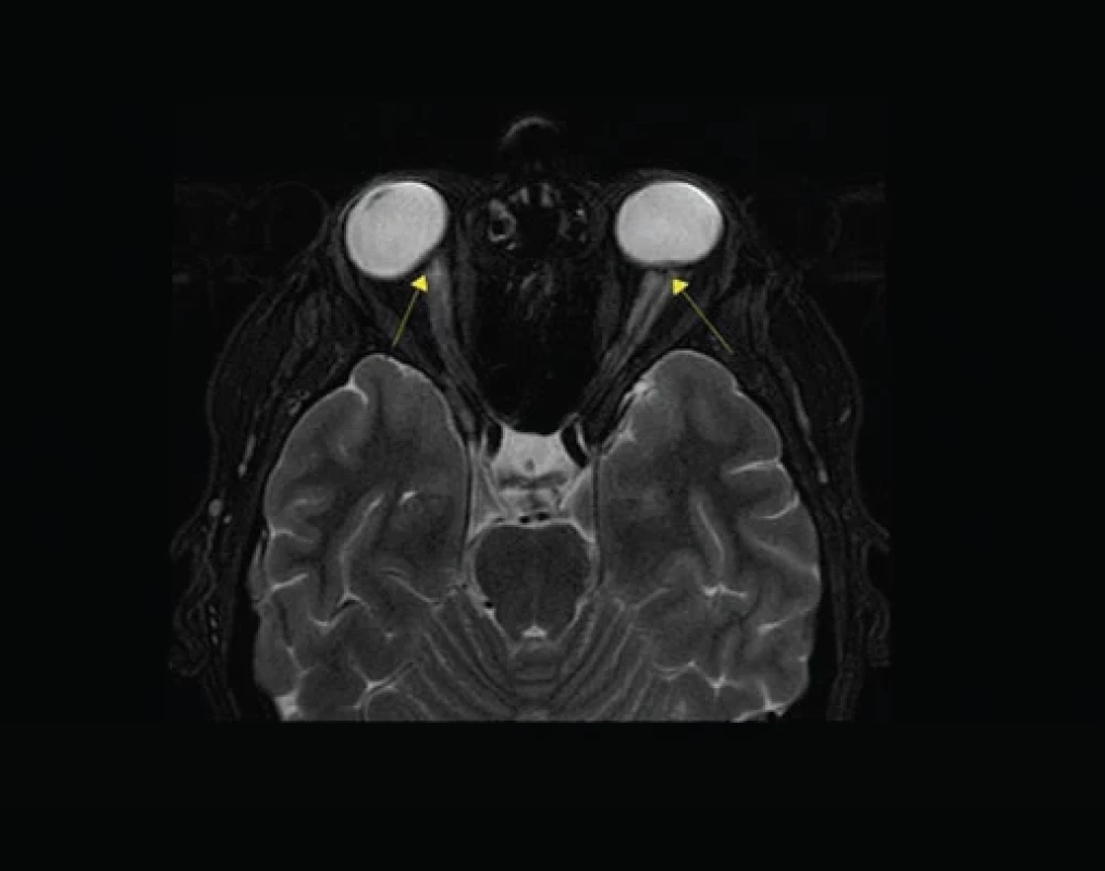 Preoperative brain MRI (T2-weighted sequence, axial plane).