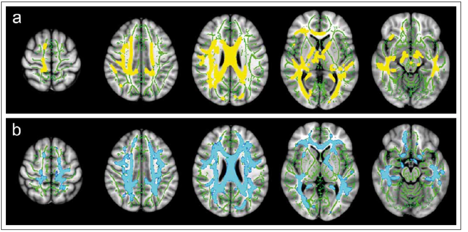Statistické „voxel-based“ porovnání hodnot frakční anizotropie (FA) (a) a střední difuzivity (MD) (b) mezi skupinou 35 pacientů s klinicky izolovaným syndromem a skupinou 32 zdravých dobrovolníků pomocí aplikace TBSS (Tract-Based Spatial Statistics).
Fig. 6. Statistical “voxel-based” comparison of fractional anisotropy (FA) (a) and mean diffusivity (MD) (b) values between a group of 35 patients with clinically isolated syndrome and a group of 32 healthy volunteers using a TBSS (tract-based spatial statistics) application.