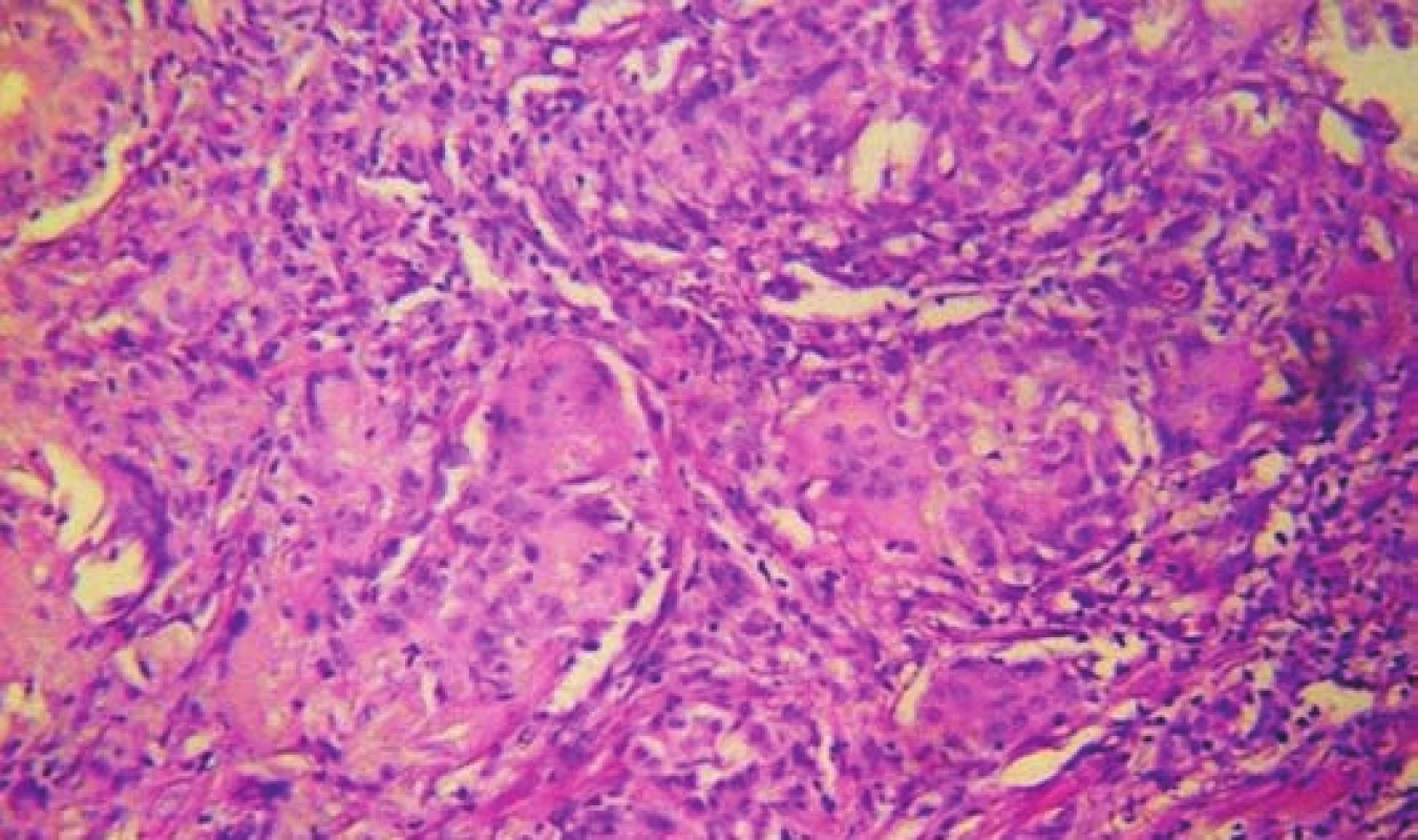 Granulom a drobné pravděpodobně cizorodé tělísko v oblasti ulcerace, (zvětšení 200x)