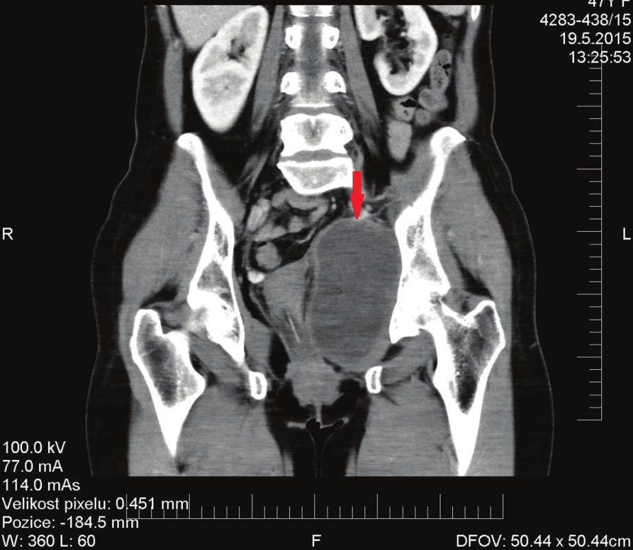 CT vyšetření po chemoradioterapii
Fig. 2: CT scan after chemoradiotherapy