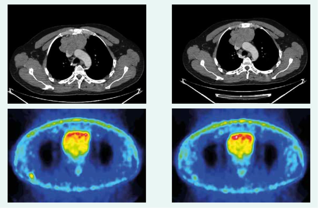CT a PET CT z novembra roku 2016. Z archívu spoluautorky MUDr. M. Černej, CSc.