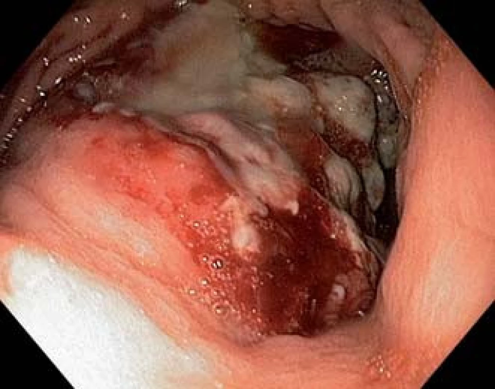 V subkardiální oblasti na zadní stěně žaludku rozsáhlá exulcerovaná infiltrace.
Fig. 1. Large ulcerated infiltration on the posterior wall of the stomach body in the subcardial area.