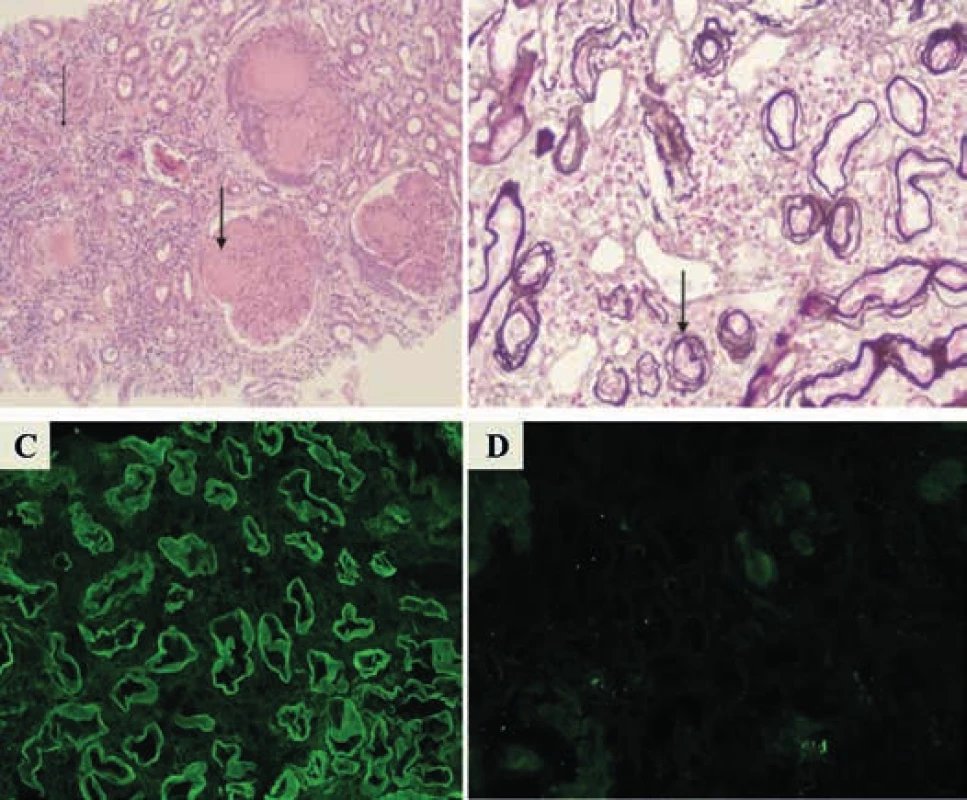 Charakteristický histologický nález biopsie ledvin u onemocnění z depozice lehkých řetězců