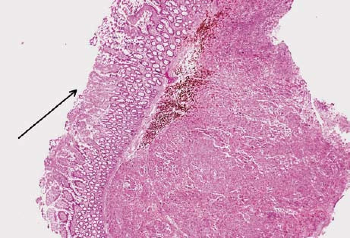 Submukózní ložisko metastázy melanomu. Na povrchu ulcerovaná sliznice tenkého střeva (šipka). Hematoxilin-eozin.
Fig. 5. Submucosal melanom metastasis. Ulcerated small bowell mucosa (arrow). Hematoxilin-eosin staning.