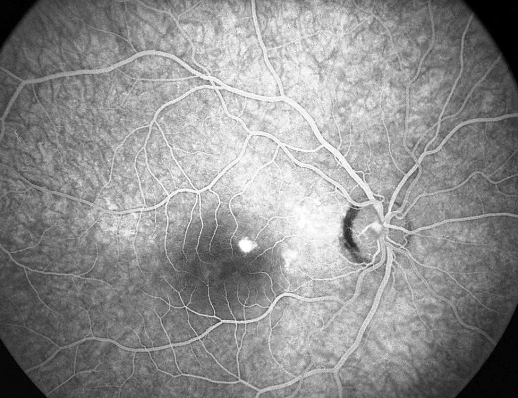 Pac. č. 4: Fluoresceínová angiografia PO: bod presakovania pri č. 1