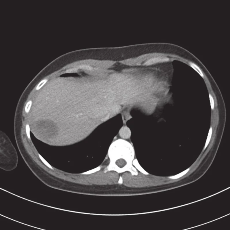 Kontrolní CT vyšetření půl roku po úrazu, drobné reziduum
Fig. 4. Follow-up examination half a year after the injury, minimal residual hematoma