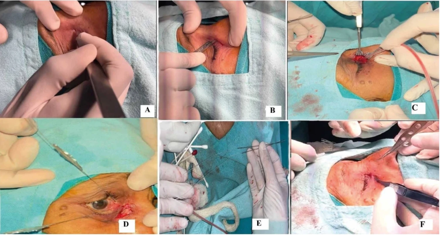  Technika zevní DCR. (A) Zakřivený řez provedený na kůži (14–16 mm) nad crista lacrimalis anterior. (B) Byla provedena pečlivá a precizní disekce k odkrytí slzného vaku. (C) K vytvoření osteotomie byly použity Kerrisonovy kostní kleště. (D) Byla provedena sondáž k uvolnění slzného vaku, aby bylo možné snadno zvednout lalok. (E) Po vytvoření laloku nosní sliznice byl připraven bikanalikulární nazolakrimální intubační stent. (F) Po provedení NLI byly slzné a nosní slizniční laloky sešity stehem Vicryl 6-0.