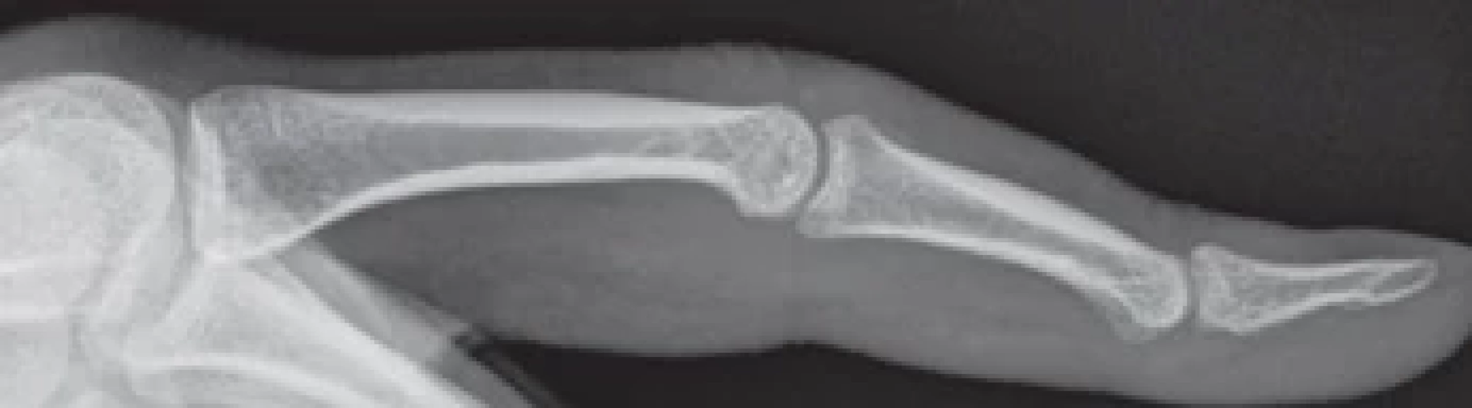 Rentgenologický snímek III. prstu pravé ruky před operační intervencí. </br>Fig. 1. X-ray of the third fi nger of the right hand before surgical intervention.