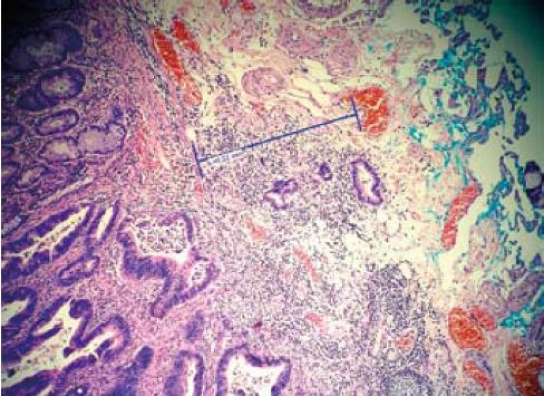 Dobře diferencovaný karcinom se submukózní invazí 520 μm (sm1).
Fig. 1. Well-differentiated carcinoma with submucosal invasion 520 μm (sm1).
