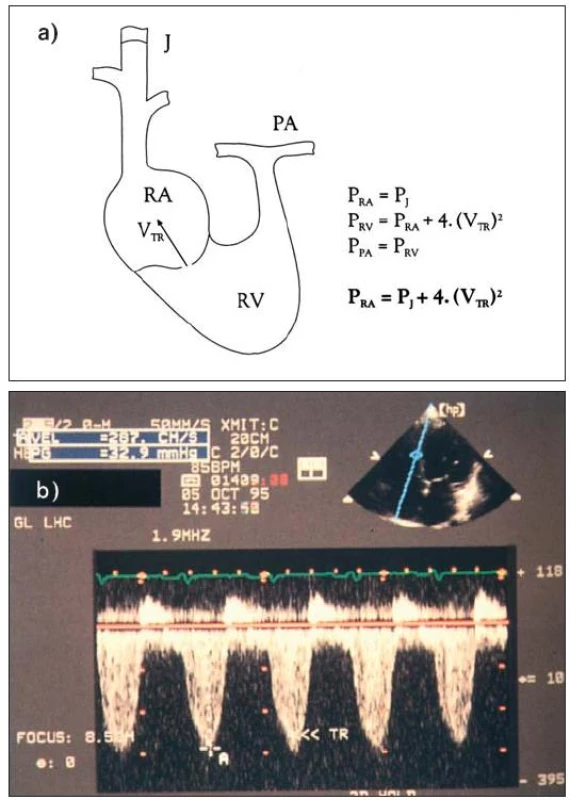 a) Diagram ukazuje podstatu zjištění plicní hypertenze za použití kontinuálního spektrálního dopplerovského vyšetření. Tlak v pravé síni je určen inspekcí jugulárního žilního pulzu. Je-li přítomna trikuspidální regurgitace, dovoluje Bernoulliho rovnice (Δ P = 4 × V<sup>2</sup>) vypočítat tlakový gradient RV – RA (tj. PK–PS) z rychlosti „jetu“. Systolický tlak v pravé komoře se rovná tlaku v plicních arteriích, pokud není obstrukce výtoku z pravé komory. b) Kontinuální spektrální dopplerovské vyšetření u trikuspidální regurgitace. Vrcholová rychlost je 2,8 m/s a odpovídá tlakovému gradientu 31 mmHg. Tlak v arteria pulmonalis se rovná tlaku v pravé síni + 31 mm Hg.