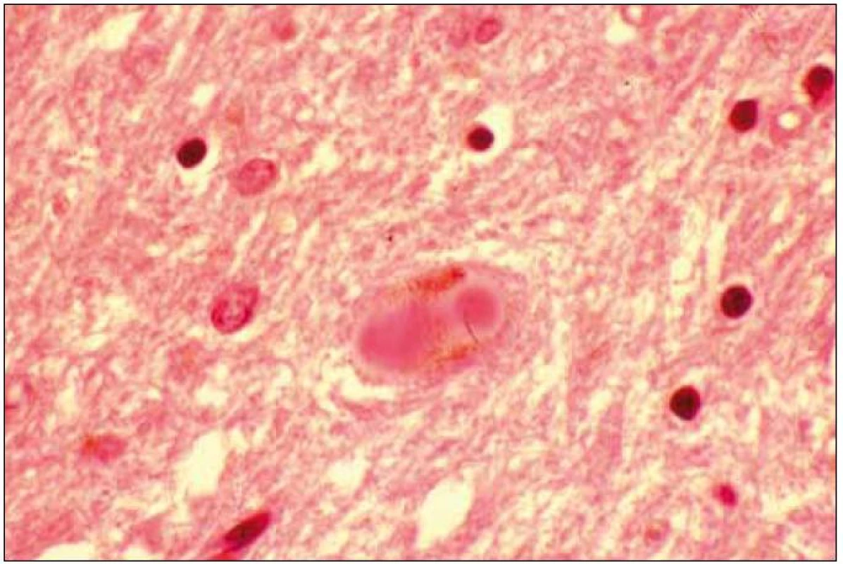 Dvě „Lewy bodies“ v cytoplazmě neuronu.
Barvení hematoxilin eozin.