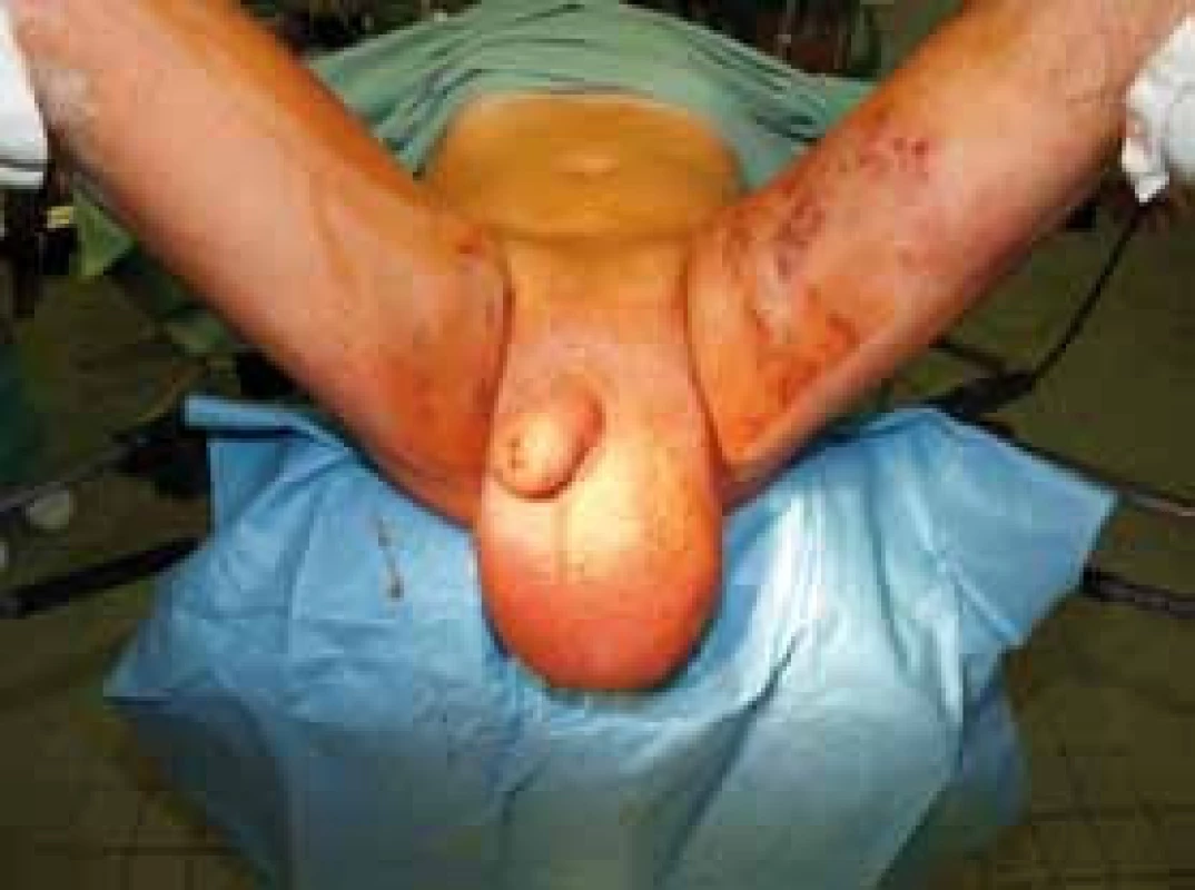 Stav před operací
A – měsíc před operací; B – těsně před operací
Fig. 1.
Preoperartive status
A – a month before; B – in operating room