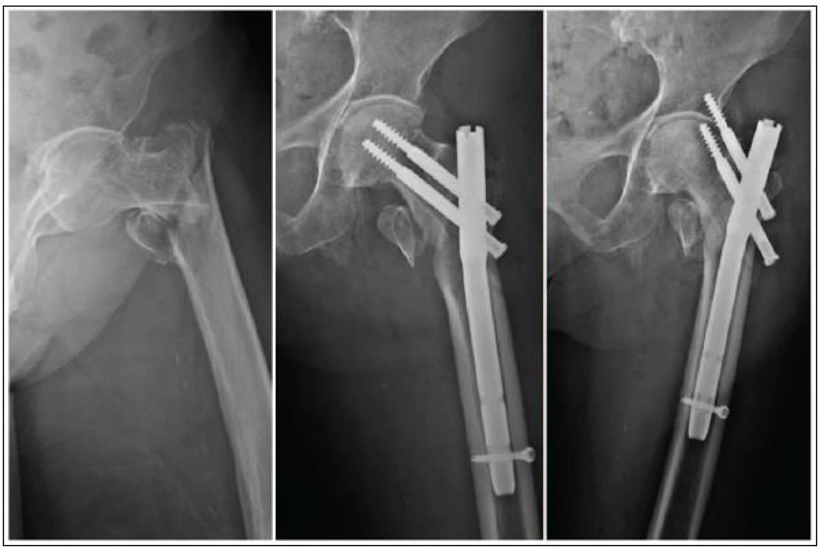 Osteosyntéza tříštivé pertrochanterické zlomeniny pomocí PFN u 86leté pacientky a její následné selhání, patrné při kontrolním RTG s odstupem 3 týdnů
