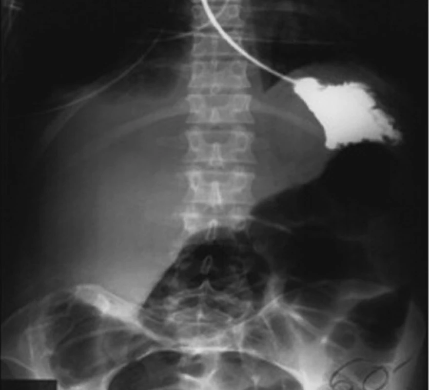 RTG snímek stop pasáže žaludkem po repozici jater při zastaralém poranění bránice vpravo
Fig. 7. An X-ray of a stop passage through the stomach after the repositioning of the liver in an old injury of the diaphragm on the right
