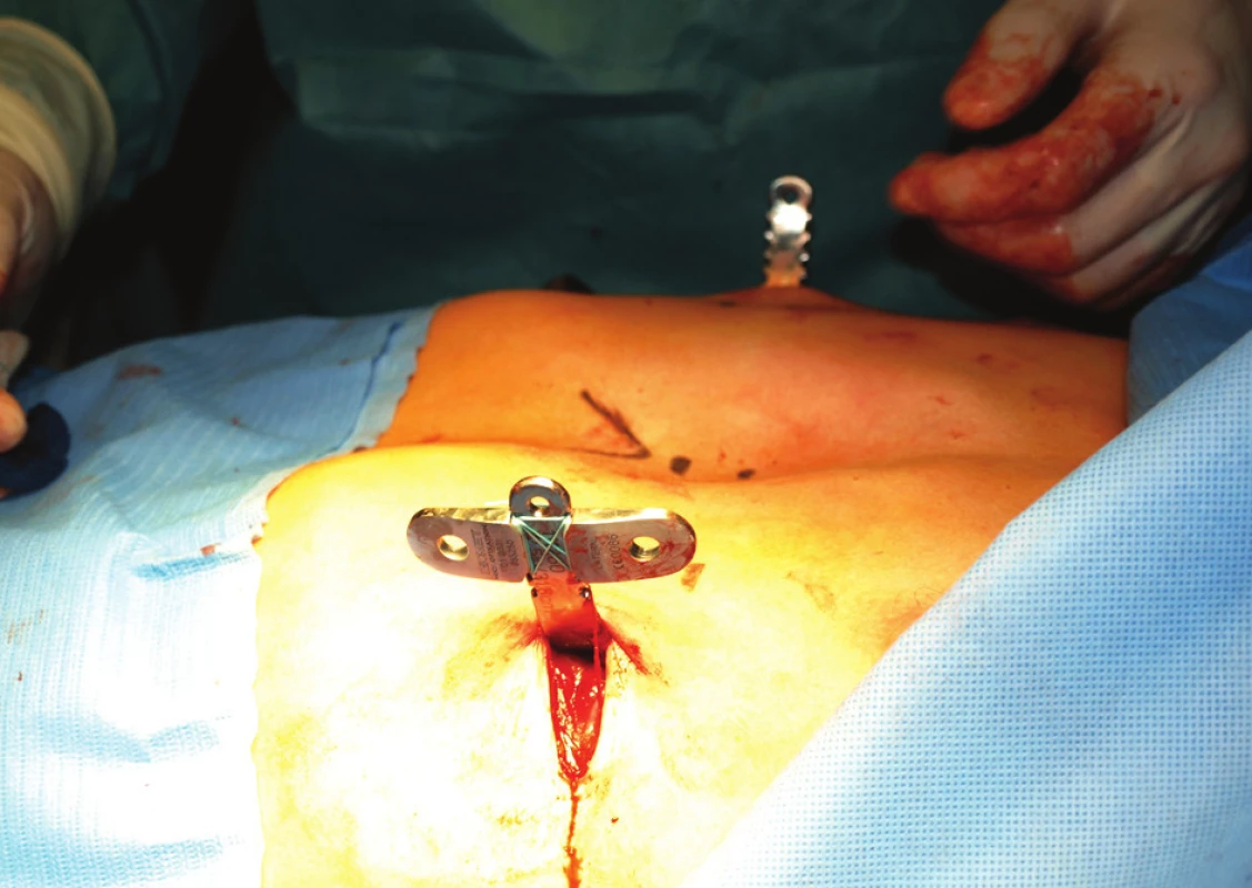 Zavedená kovová dlaha se stabilizátorem před otočením do definitivní polohy
Fig. 2: Inserted metal bar before rotation to its definitive position