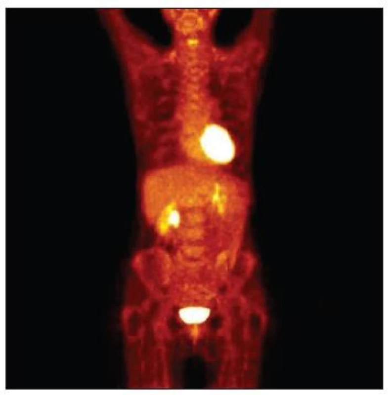 Kontrolní PET/CT – regrese uzlinových metastáz
Fig. 8. Control PET/CT – regression of the lymph node metastases