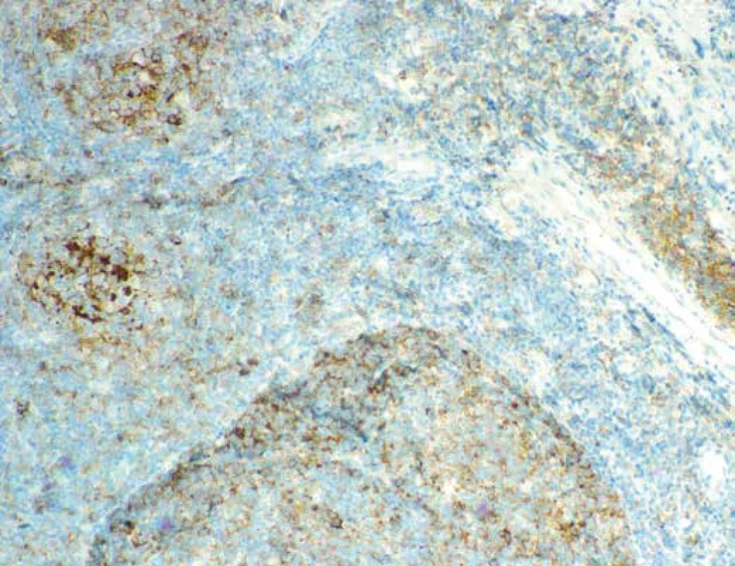Imunohistochemický průkaz exprese CD10. Zvětšení 100x.