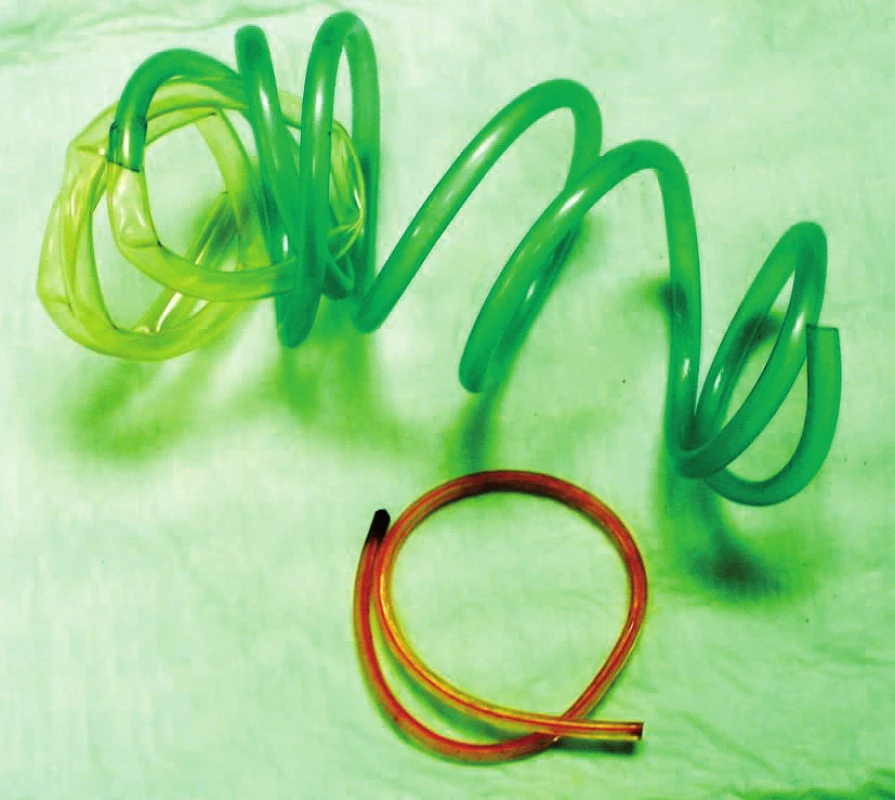 Bužírka extrahovaná z měchýře u pacienta 4
Fig. 4. Extracted plastic tube from the bladder by patient 4