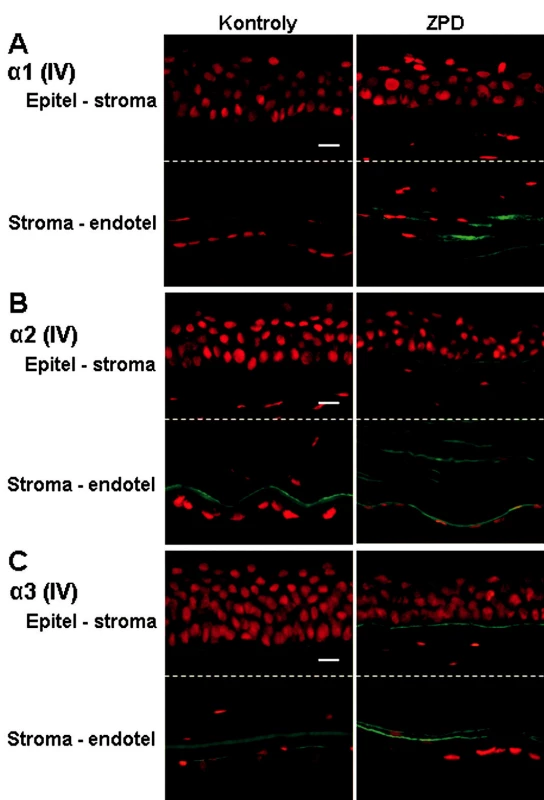 Výskyt reťazcov α1, α2 a α3 kolagénu IV v rohovkách kontrol a pacientov so ZPD. Popis: Reťazec α1 (A) bol detekovaný len v zadnej strome a na endotelovej strane Descemetovej membrány u pacientov so ZPD. Reťazec α2 (B) bol u pacientov so ZPD prítomný v bazálnej membráne epitelu, v zadnej časti stromy a na endotelovej strane Descemetovej membrány. Výskyt reťazca α3 (C) sa príliš nelíšil medzi kontrolnou a patologickou rohovkou (pozitivita v bazálnej membráne epitelu, na endotelovej strane Descemetovej membrány; u pacienta so ZPD zdvojená línia). Signál pre všetky reťazce α je zelený (FITC – Fluorescein isothiocyanate) a jadrá sú zviditeľnené propidium jodidom (PI). Mierka znázorňuje 10 μm