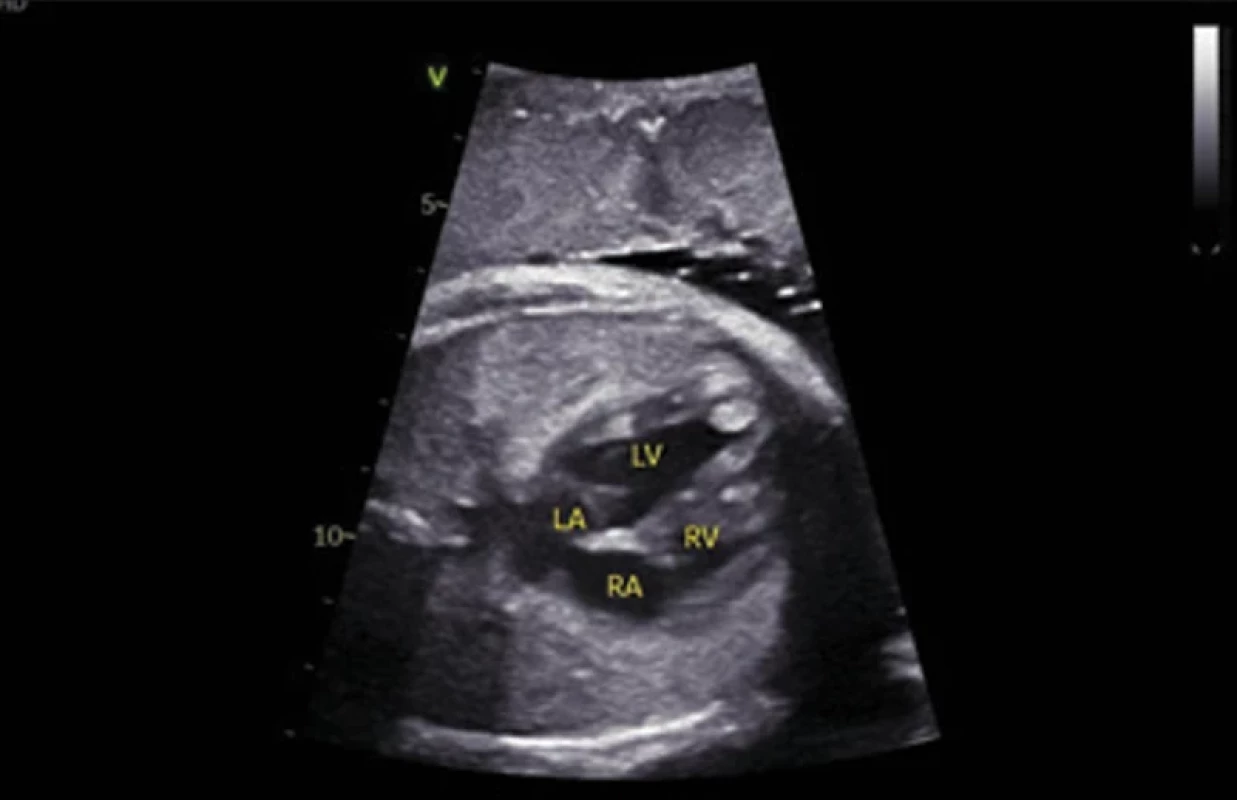 Fetální echokardiografi cké vyšetření plodu prenatálně ve 31 + 4 gestačním  týdnu. V hrotu a volné stěně levé komory (LV) jsou patrné hyperintenzní rhabdomyomy.  Levá síň (LA), pravá síň (RA), pravá komora (RV). Fig. 1. Fetal echocardiographic examination of the fetus prenatally at 31 + 4 weeks of  gestation. Hyperintense rhabdomyomas are visible in the apex and free wall of the left  ventricle (LV). Left atrium (LA), right atrium (RA), right ventricle (RV).