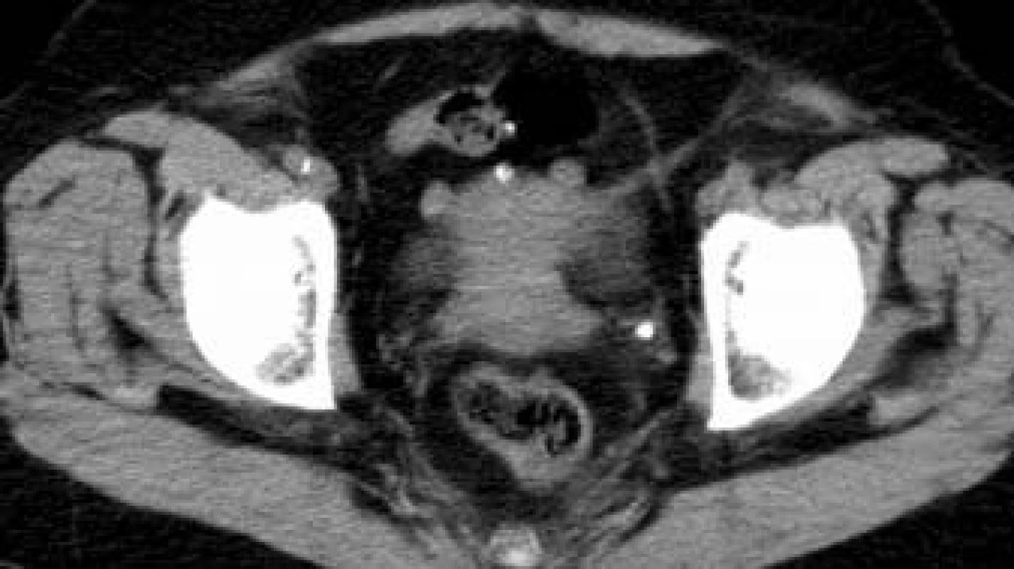 Levostranná distální ureterolitiáza.