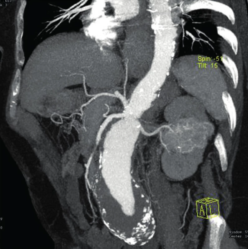 Juxtarenální aneuryzma břišní aorty a renální karcinom střední části levé ledviny
Fig. 2: Juxtarenal abdominal aortic aneurysm and renal carcinoma of the middle part of the left kidney