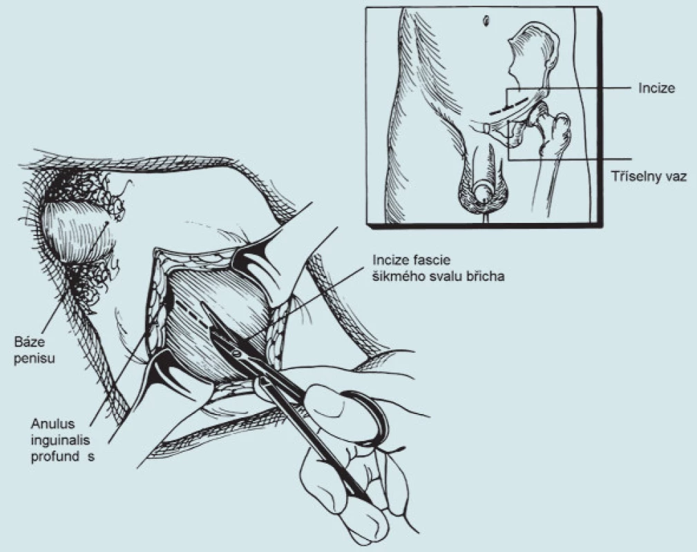 Orchidektomie.