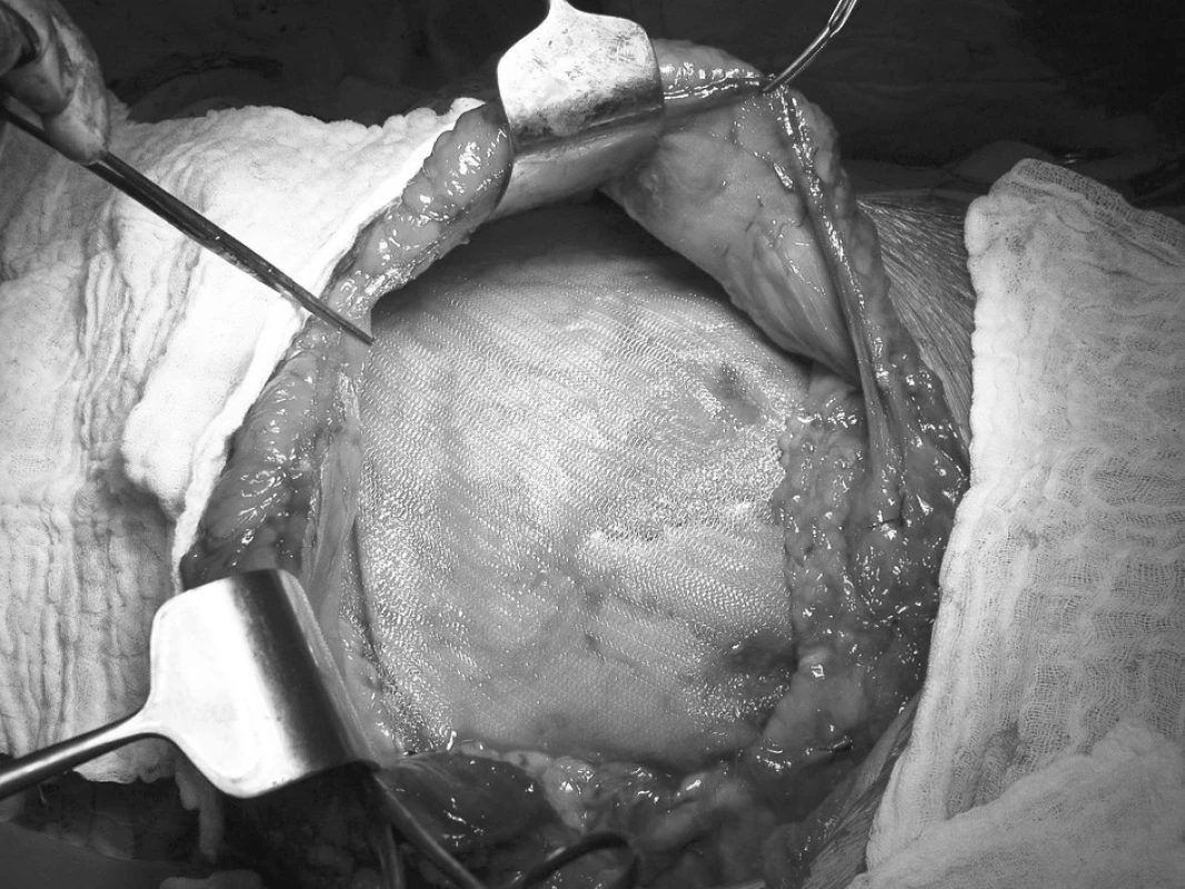 Peroperační snímek – open-IPOM plastika sítí DynaMesh-IPOM o velikosti 30x30 cm
Pic. 6. Intraoperative photo – open-IPOM hernioplasty with DynaMesh-IPOM mesh of size 30x30 cm