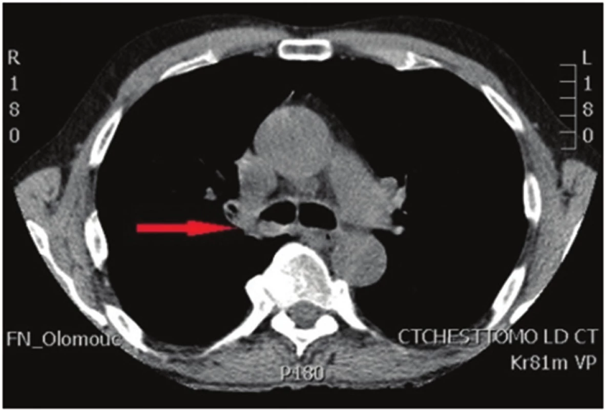 Počítačová tomografie hrudníku: nádorové postižení kariny
Fig. 1: Computed tomography of the chest: tumor of the carina
