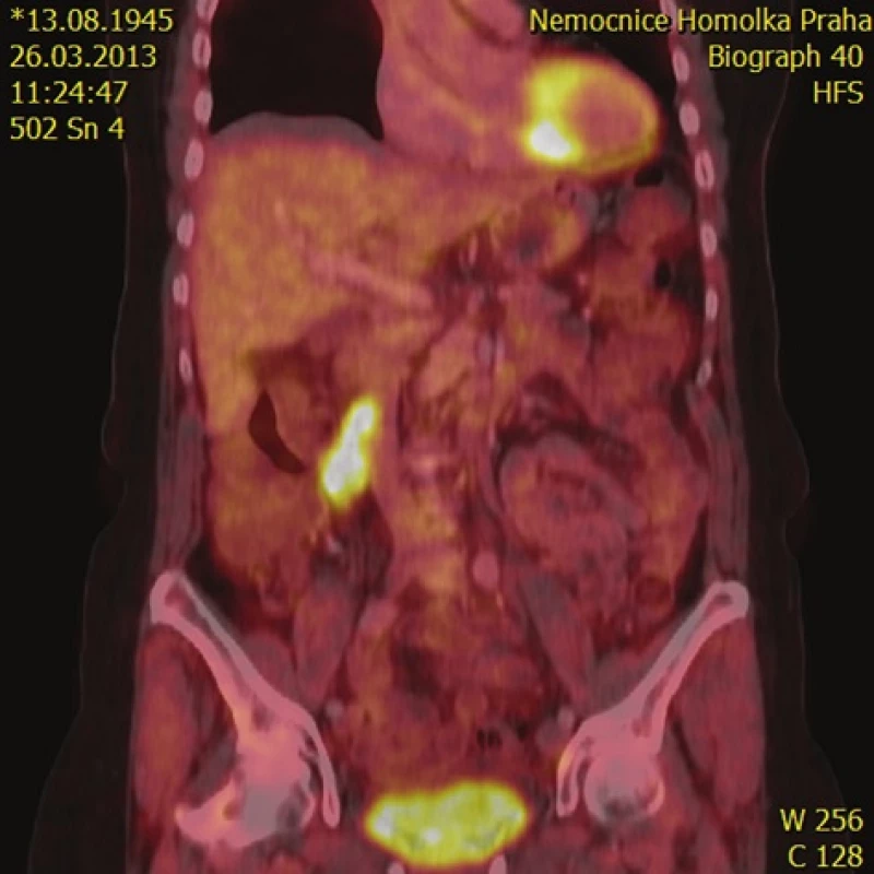 Sagitální řez PET-CT v místě primárního tumoru
Fig. 1: PET-CT sagittal cross section with the primary tumor visible