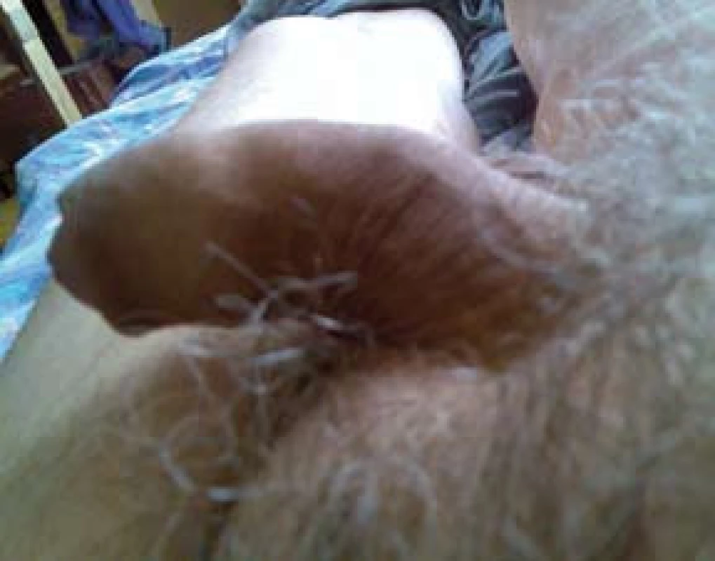 Stav po výkonu (3 měsíce od SWT)
Fig. 2. Stage after treatment (3 months after SWT)