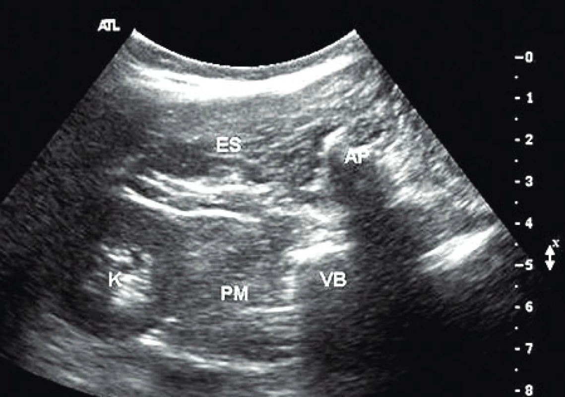 Ultrazvukový obraz pro psoas kompartment blok
(zdroj: veřejná doména, www.nysora.com)
ES – m. erector spinae, AP – trnový výběžek obratle, VB – tělo obratle, PM – m. psoas major, K – ledvina
