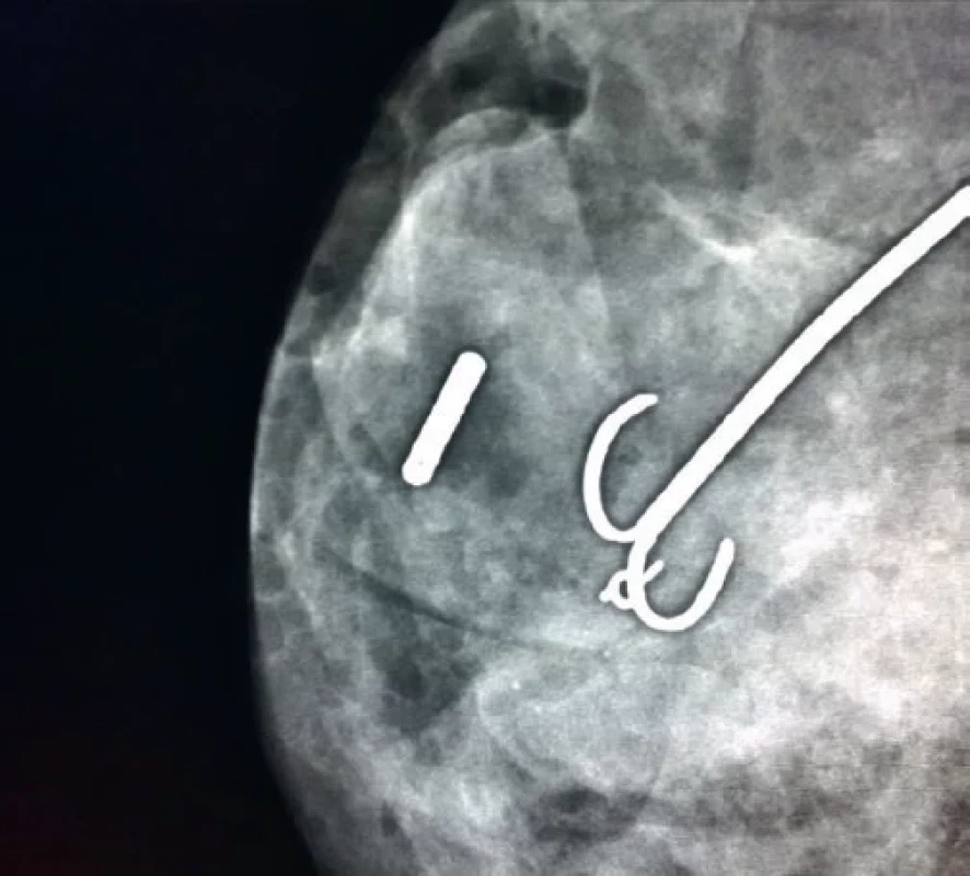 Tumor prsu značen zrnem I-125 a Frankovým vodičem. / Tumor of the breast marked with I-125 seed and wire localization.