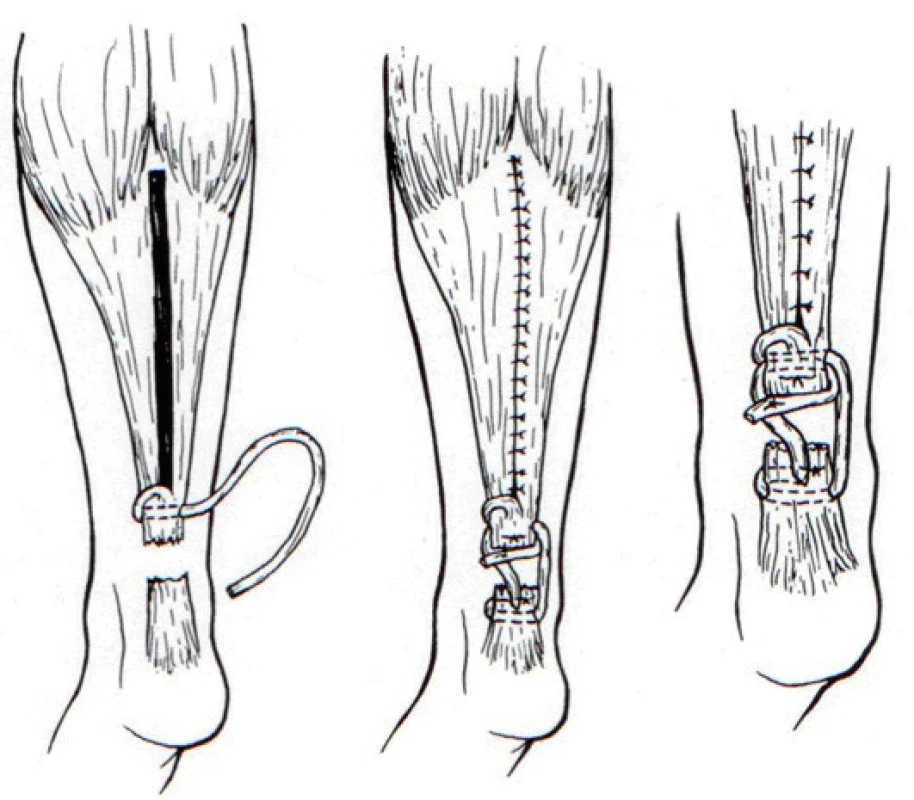 Plastika dle Boswortha [2]
(Volně podle Bosworth, D.M. Repair of defects in the tendo achillis. The Journal of Bone and Joint Surgery. 38A, 111–114, 1956).