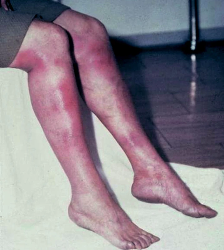 Erythema nodosum