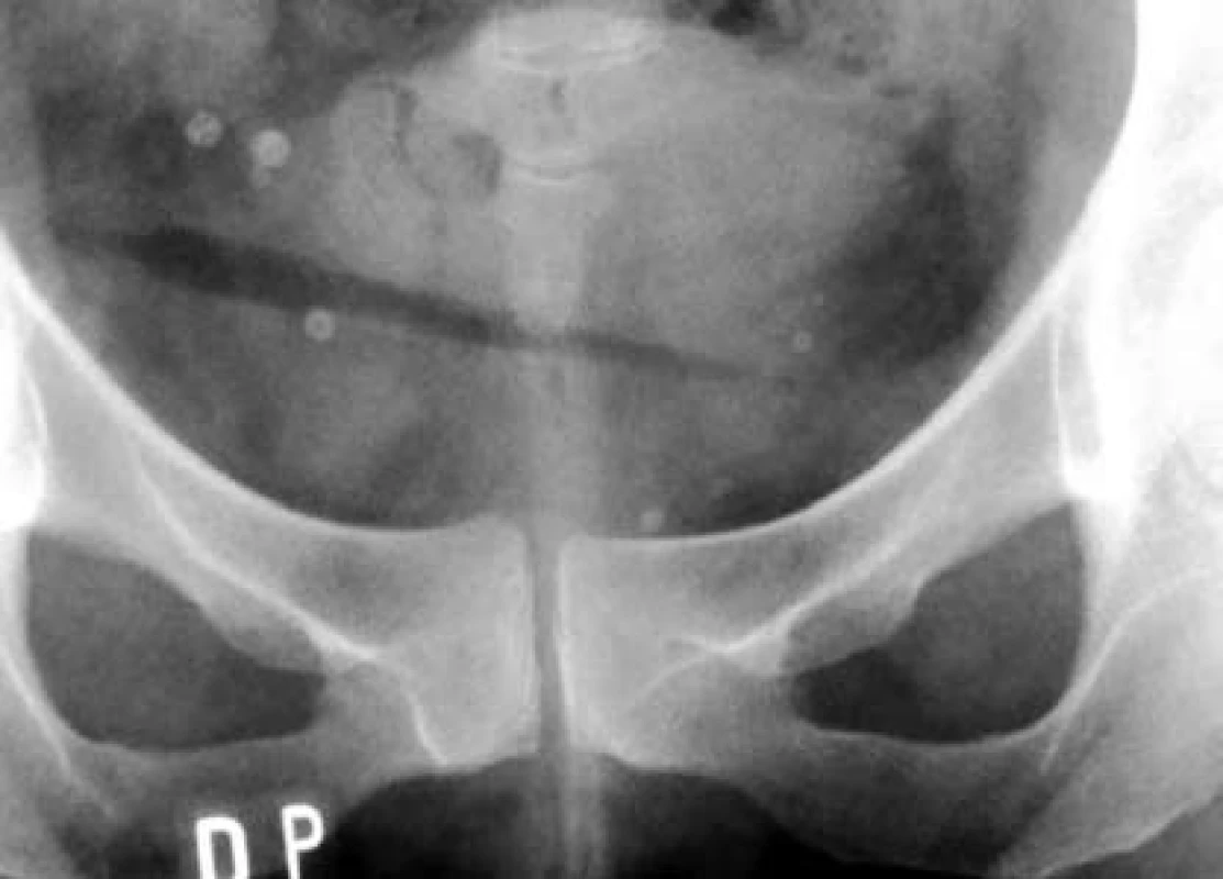 Cystogram – redispero v močovém měchýři
Pen in urinary bladder