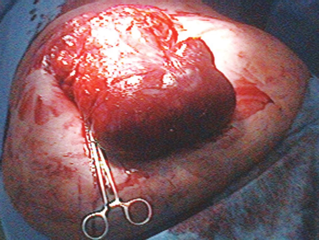 Kýlní vak
Fig. 6. Hernial bag