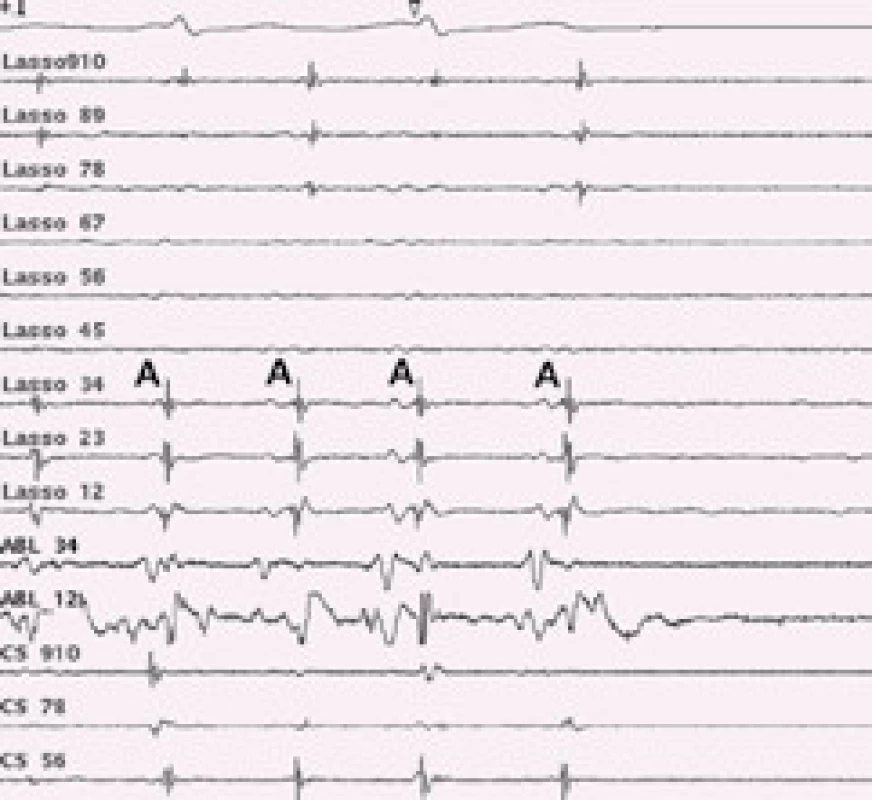 Intrakardiální EKG záznam u katetrové ablace permanentní fibrilace síní.
U pacienta s dezorganizovanou permanentní fibrilací síní došlo po komplexní ablaci v levé síni k organizaci do levosíňové monomorfní tachykardie. Po aplikaci radiofrekvenční energie do kritického místa reentry okruhu monomorfní síňové tachykardie dochází k nástupu sinusového rytmu. A – pravidelná síňová aktivita monomorfní síňové tachykardie, následně sinusový stah. Lasso – cirkulární mapovací katetr, snímá aktivitu z plicní žíly, CS – záznam z koronárního sinu, ABL – záznam z ablačního katetru.