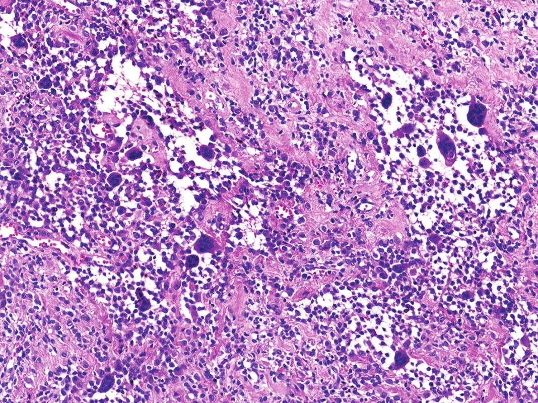 Nezvyklé rozvolnění původní kompaktní buněčné skladby s tvorbou nápadných pseudoalveolárních/pseudoangiomatózních formací (HE, 200x).