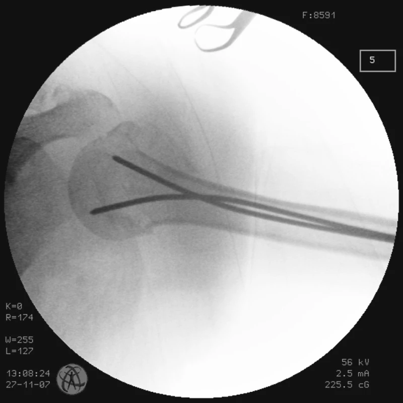 RTG obraz po primární zavřené repozici zlomeniny proximálního humeru a transfixaci zlomeniny 2 K-dráty u pacienta č. 1
Fig. 2. X-ray view following primary closed proximal humeral repositioning and the fracture transfixation with 2K wires in the patient No. 1
