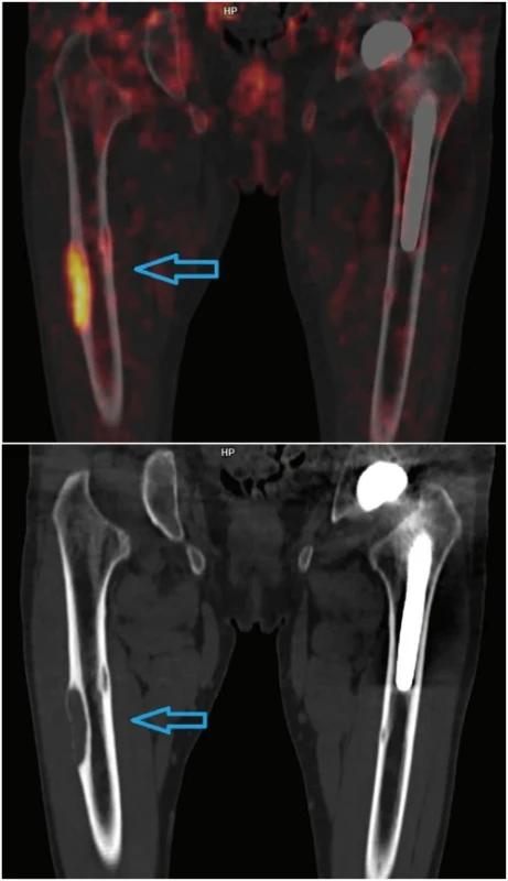 Subperiostální projasnění v zevním okraji diafýzy pravého femuru. Typický obraz osteitis fibrosa cystica (hnědý tumor). Zřetelný je hypermetabolismus glukózy v lézi.