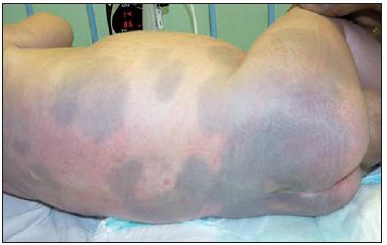 Početné modrosivé mongolské škvrny splývajúceho charakteru s maximom na chrbte, gluteách a stehnách.
Fig. 2. A multiple blue-grey mongolian spot of coinciding character with maximum on the spite, glutei and thighs.