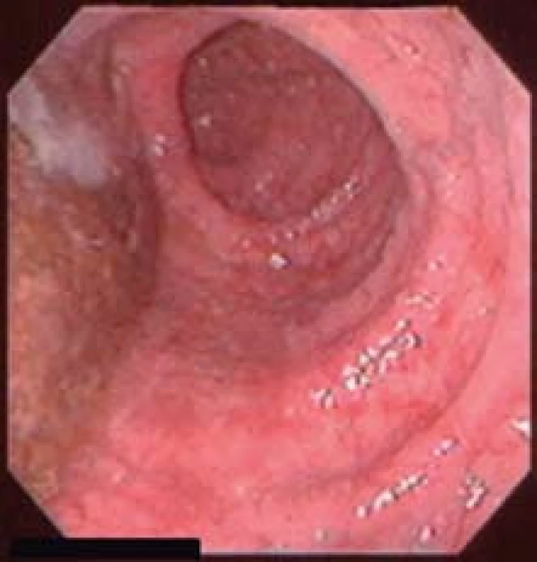 Endoskopický obraz megaezofágu. Pažerák je výrazne dilatovaný, intraluminálne prítomné tekuté zvyšky potravy.
Fig. 2. Endoscopic image of the megaesophagus. The oesophagus is extremely dilated, retained content is visible.